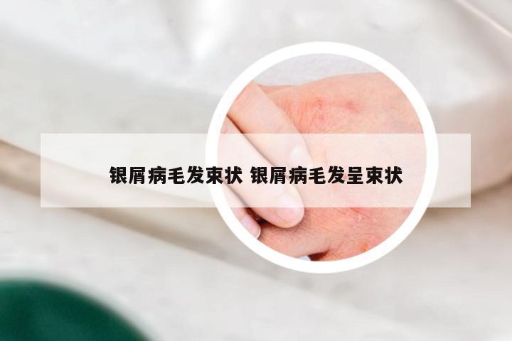 银屑病毛发束状 银屑病毛发呈束状