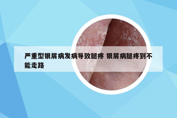 严重型银屑病发病导致腿疼 银屑病腿疼到不能走路