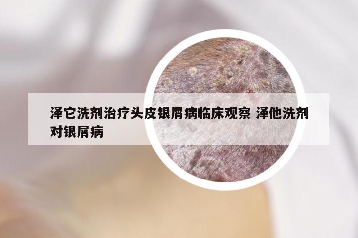 泽它洗剂治疗头皮银屑病临床观察 泽他洗剂对银屑病