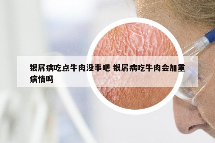 银屑病吃点牛肉没事吧 银屑病吃牛肉会加重病情吗