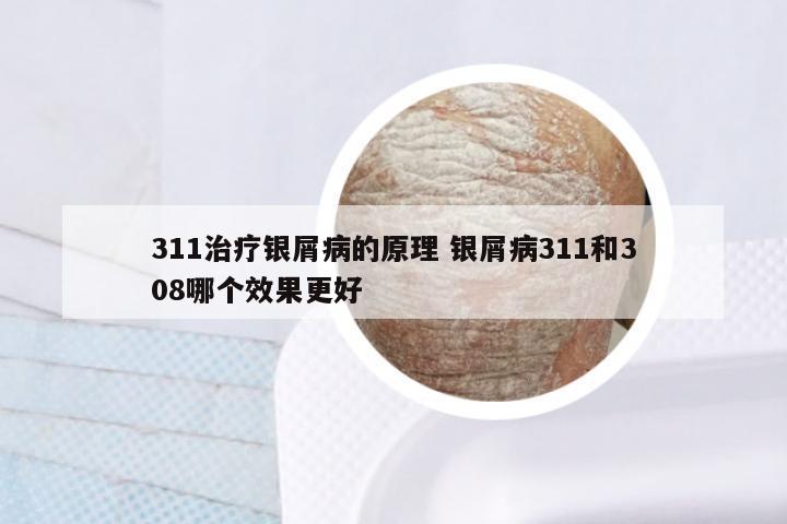 311治疗银屑病的原理 银屑病311和308哪个效果更好