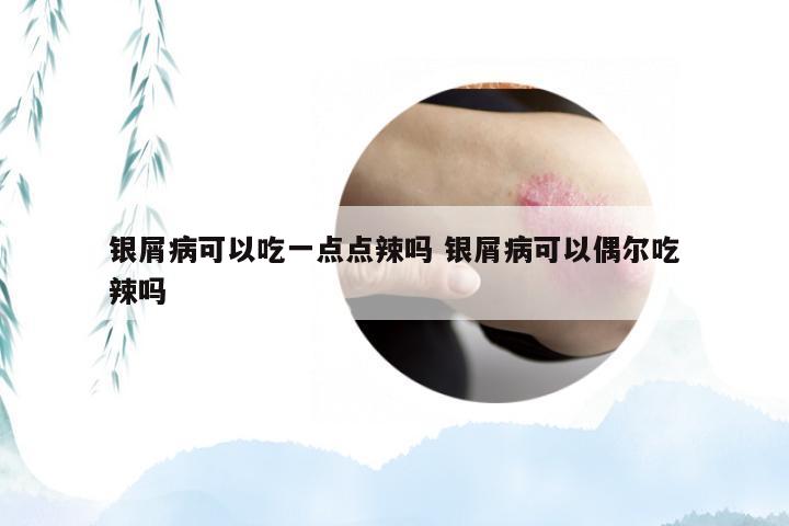 银屑病可以吃一点点辣吗 银屑病可以偶尔吃辣吗