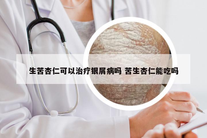 生苦杏仁可以治疗银屑病吗 苦生杏仁能吃吗