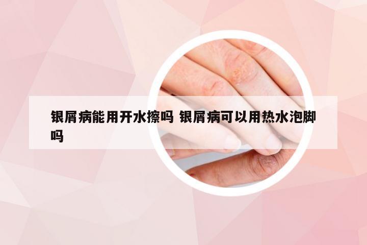 银屑病能用开水擦吗 银屑病可以用热水泡脚吗