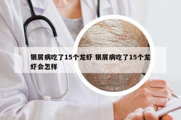 银屑病吃了15个龙虾 银屑病吃了15个龙虾会怎样