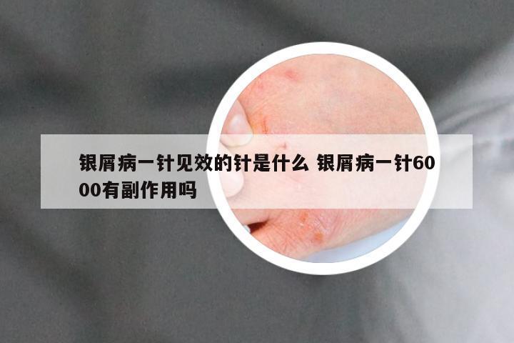 银屑病一针见效的针是什么 银屑病一针6000有副作用吗