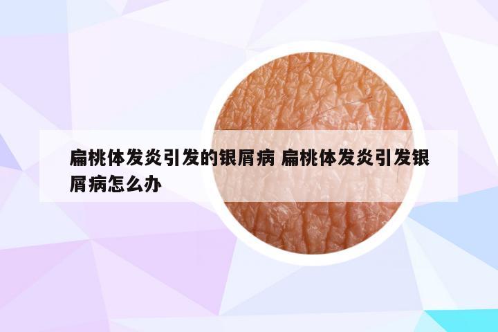 扁桃体发炎引发的银屑病 扁桃体发炎引发银屑病怎么办