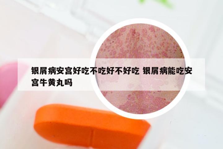 银屑病安宫好吃不吃好不好吃 银屑病能吃安宫牛黄丸吗