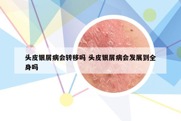 头皮银屑病会转移吗 头皮银屑病会发展到全身吗