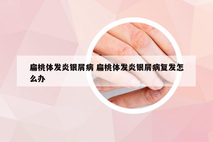 扁桃体发炎银屑病 扁桃体发炎银屑病复发怎么办