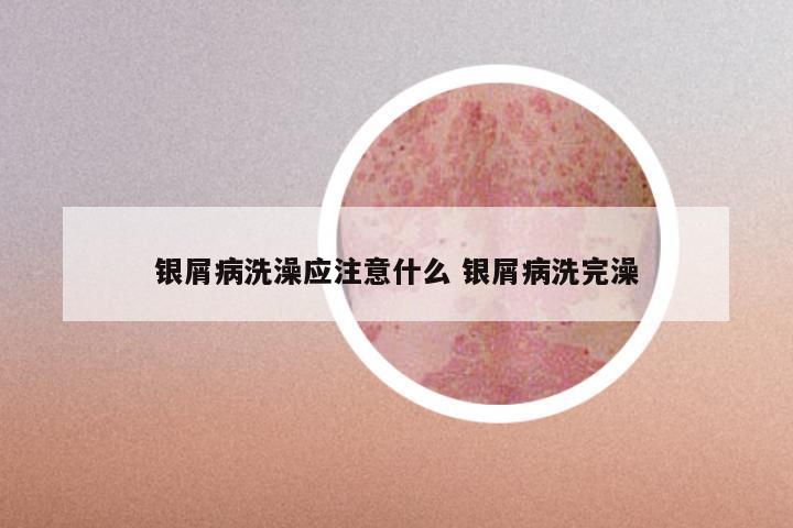 银屑病洗澡应注意什么 银屑病洗完澡