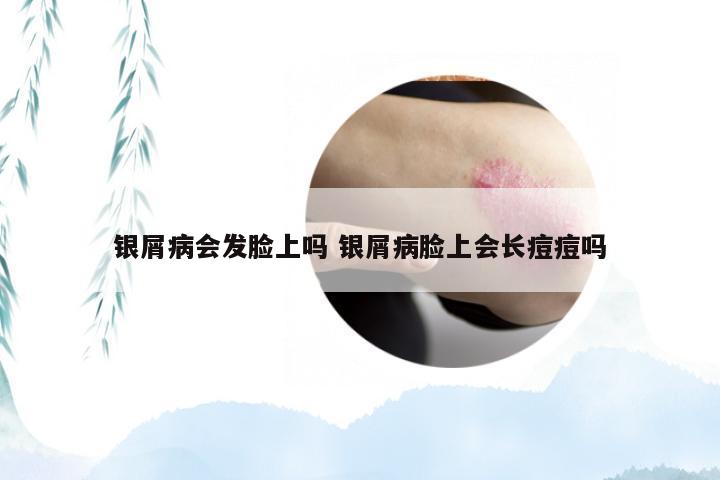 银屑病会发脸上吗 银屑病脸上会长痘痘吗