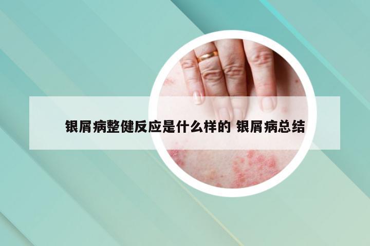 银屑病整健反应是什么样的 银屑病总结