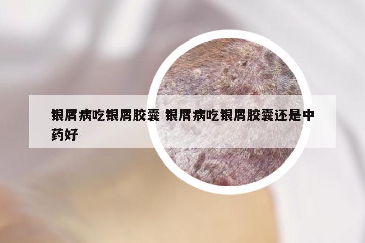 银屑病吃银屑胶囊 银屑病吃银屑胶囊还是中药好