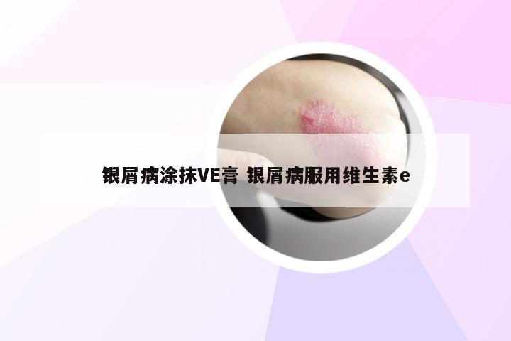 银屑病涂抹VE膏 银屑病服用维生素e