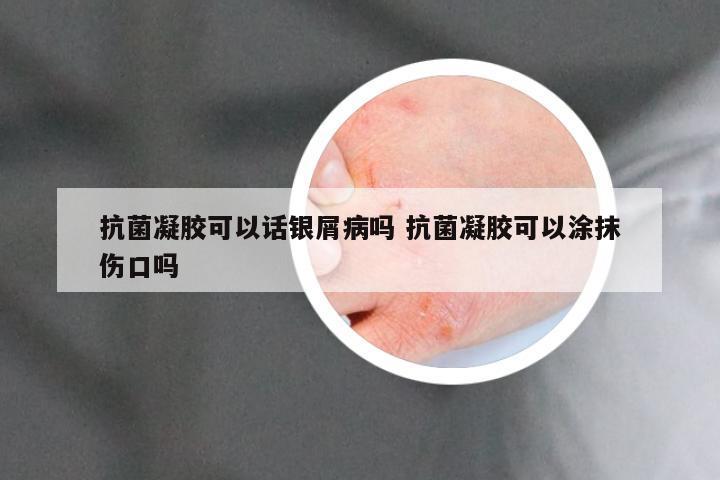 抗菌凝胶可以话银屑病吗 抗菌凝胶可以涂抹伤口吗