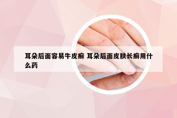 耳朵后面容易牛皮癣 耳朵后面皮肤长癣用什么药