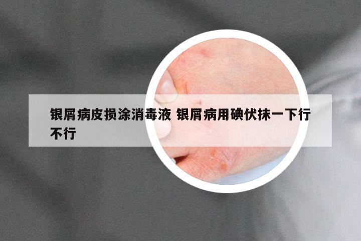 银屑病皮损涂消毒液 银屑病用碘伏抹一下行不行