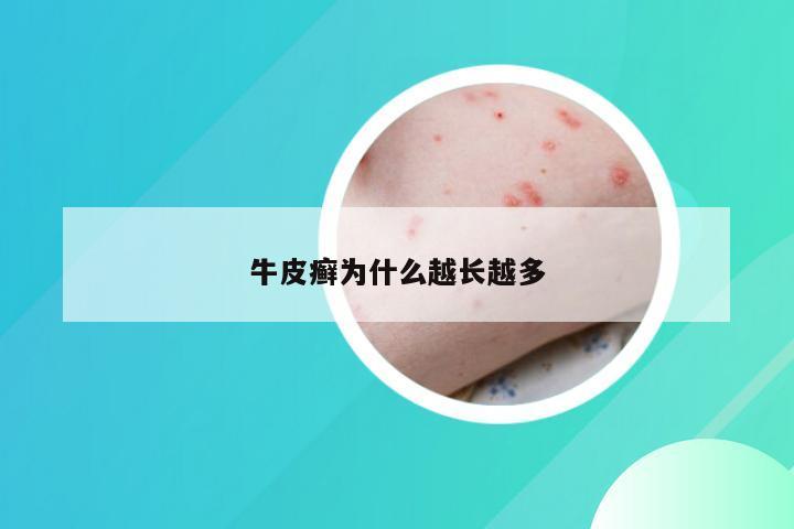 牛皮癣为什么越长越多