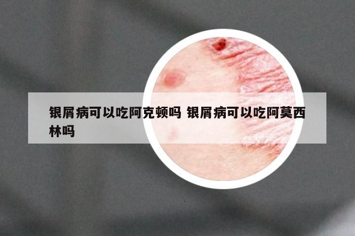 银屑病可以吃阿克顿吗 银屑病可以吃阿莫西林吗