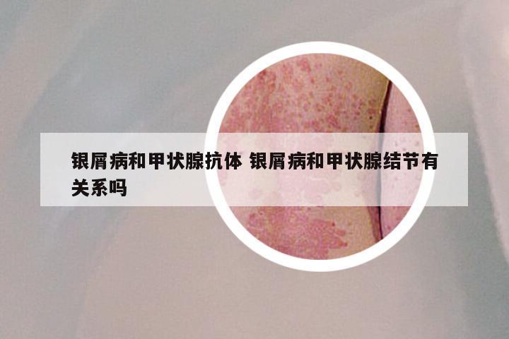 银屑病和甲状腺抗体 银屑病和甲状腺结节有关系吗