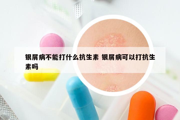 银屑病不能打什么抗生素 银屑病可以打抗生素吗