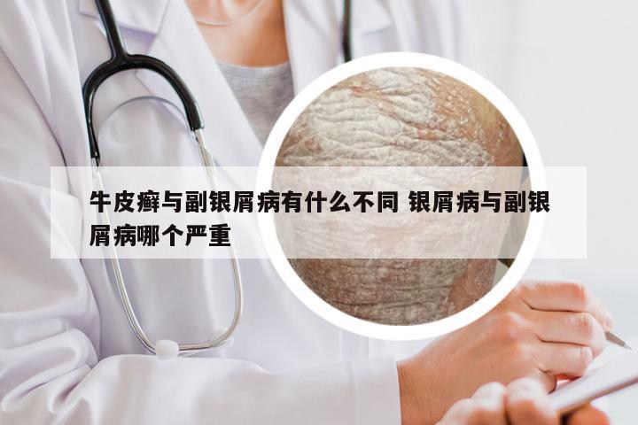 牛皮癣与副银屑病有什么不同 银屑病与副银屑病哪个严重