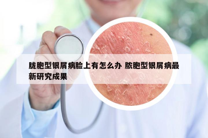 胧胞型银屑病脸上有怎么办 脓胞型银屑病最新研究成果