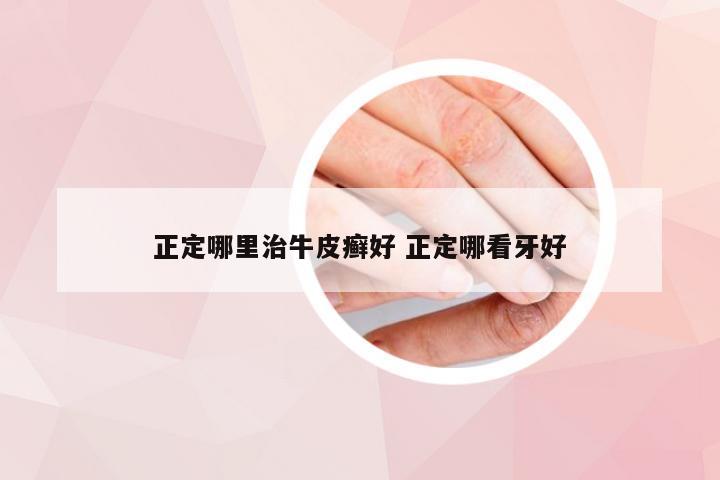 正定哪里治牛皮癣好 正定哪看牙好