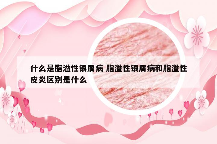 什么是脂溢性银屑病 脂溢性银屑病和脂溢性皮炎区别是什么