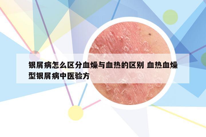 银屑病怎么区分血燥与血热的区别 血热血燥型银屑病中医验方