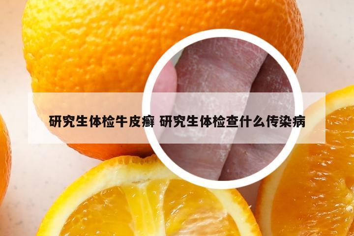 研究生体检牛皮癣 研究生体检查什么传染病