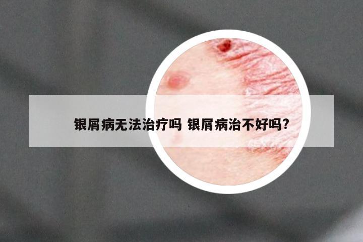 银屑病无法治疗吗 银屑病治不好吗?