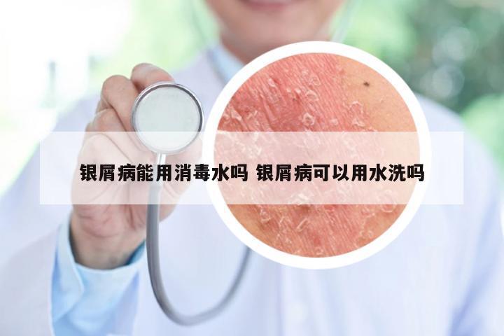 银屑病能用消毒水吗 银屑病可以用水洗吗