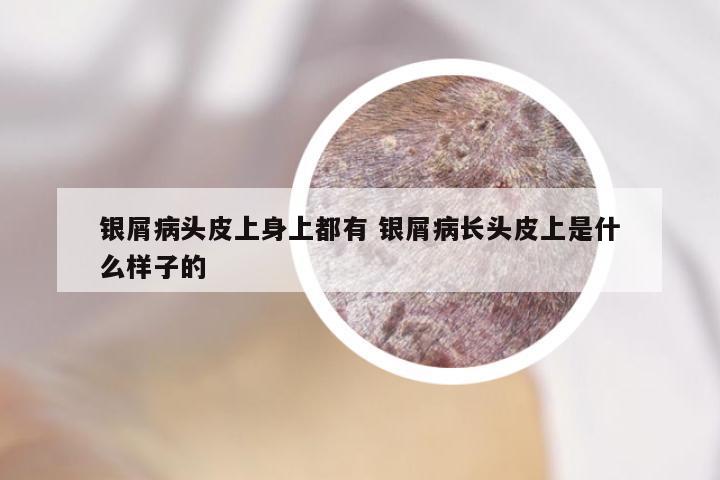 银屑病头皮上身上都有 银屑病长头皮上是什么样子的