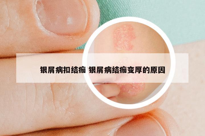 银屑病扣结痂 银屑病结痂变厚的原因