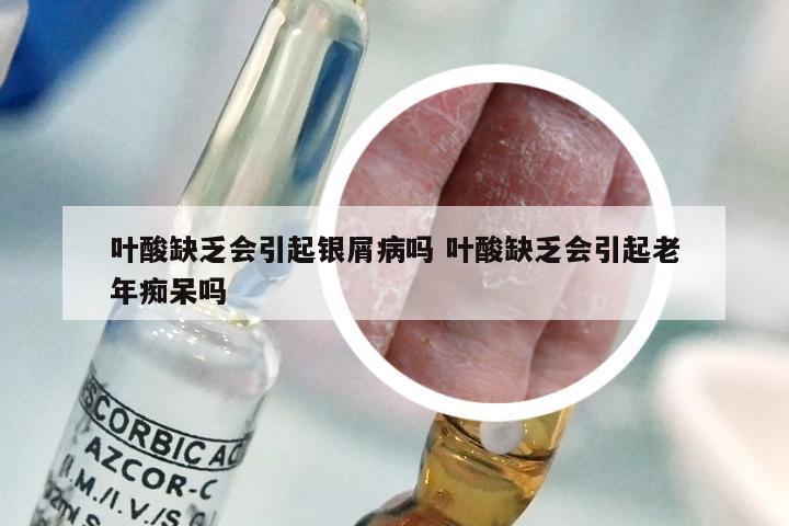 叶酸缺乏会引起银屑病吗 叶酸缺乏会引起老年痴呆吗