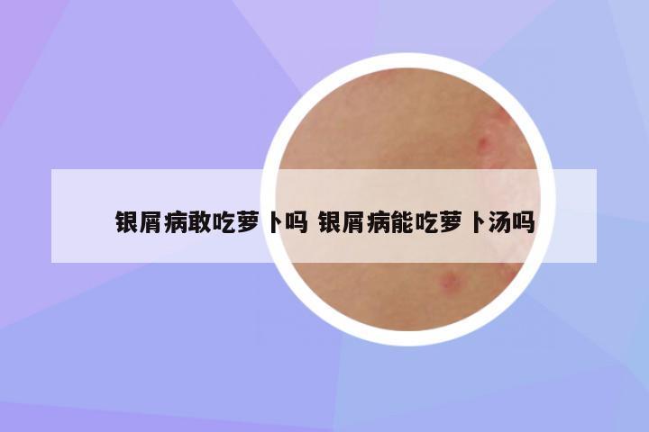 银屑病敢吃萝卜吗 银屑病能吃萝卜汤吗