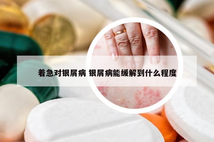 着急对银屑病 银屑病能缓解到什么程度