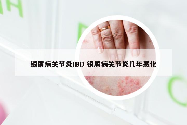 银屑病关节炎IBD 银屑病关节炎几年恶化