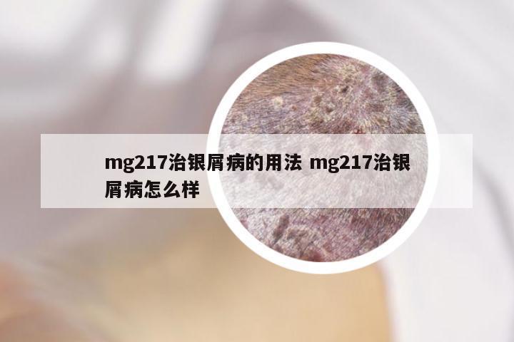 mg217治银屑病的用法 mg217治银屑病怎么样