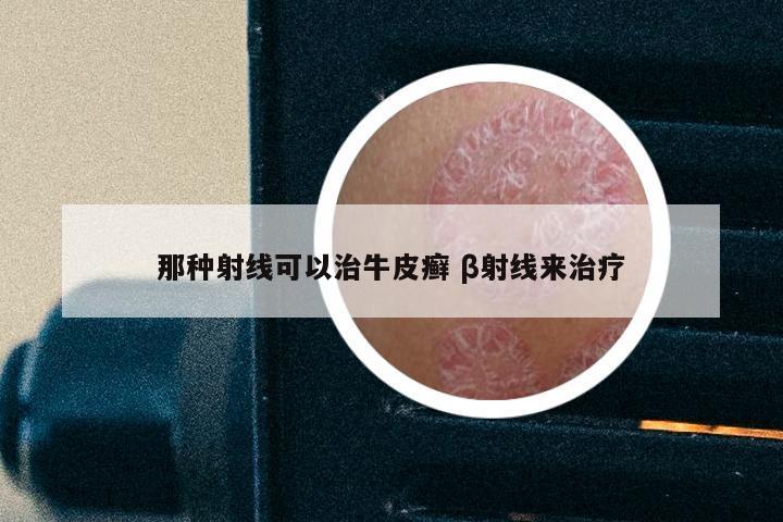 那种射线可以治牛皮癣 β射线来治疗