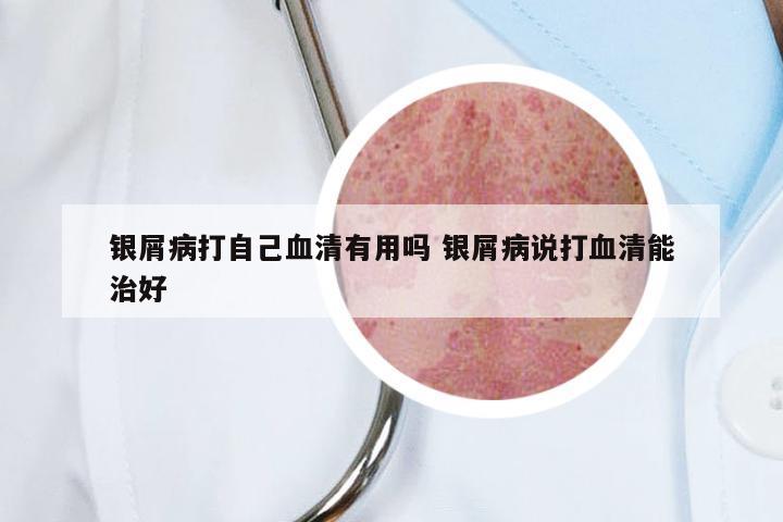 银屑病打自己血清有用吗 银屑病说打血清能治好