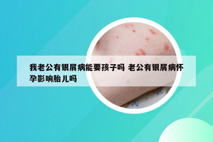 我老公有银屑病能要孩子吗 老公有银屑病怀孕影响胎儿吗