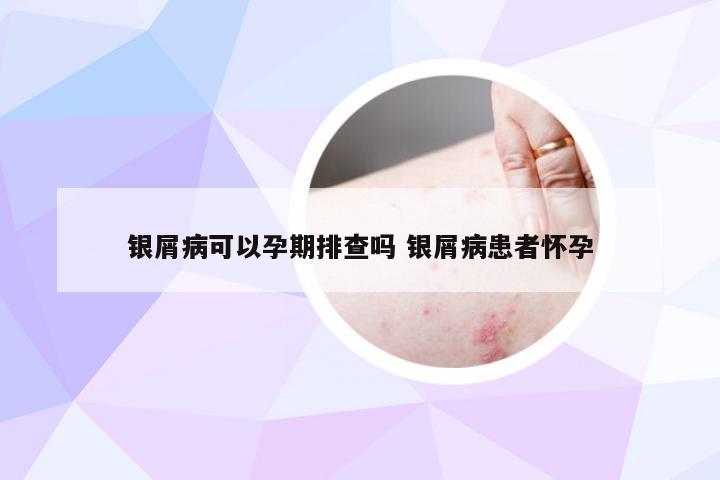 银屑病可以孕期排查吗 银屑病患者怀孕