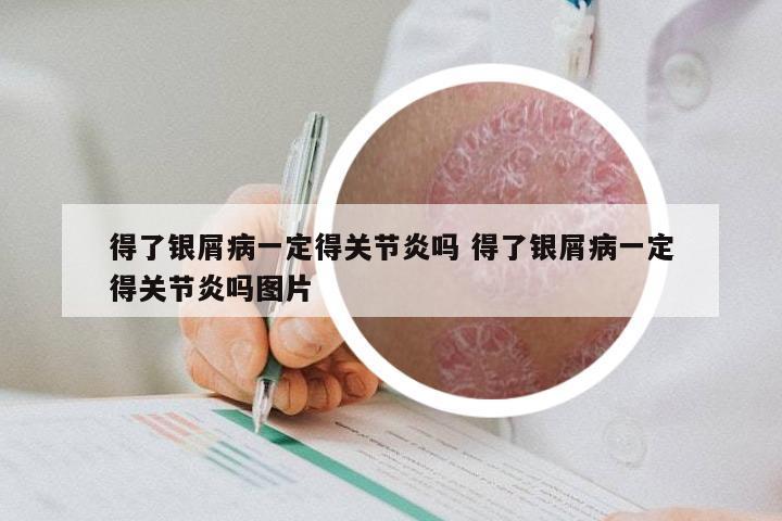 得了银屑病一定得关节炎吗 得了银屑病一定得关节炎吗图片