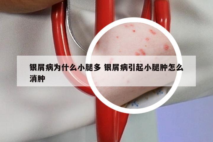 银屑病为什么小腿多 银屑病引起小腿肿怎么消肿