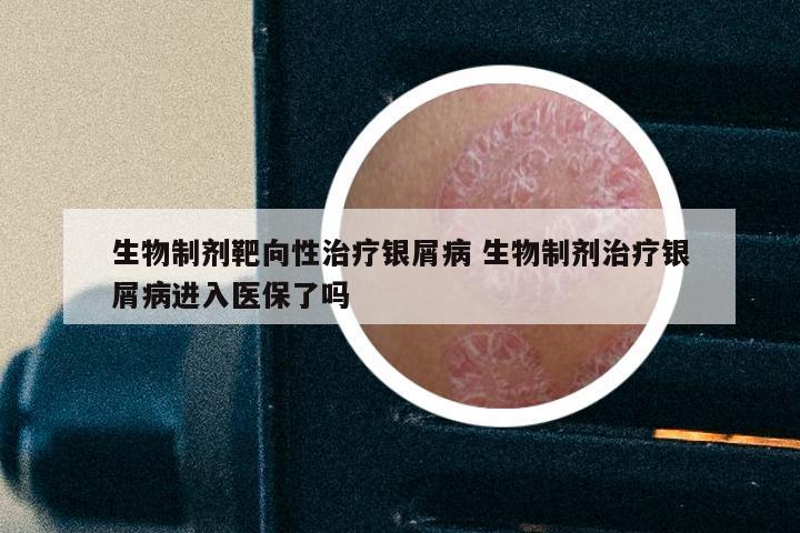 生物制剂靶向性治疗银屑病 生物制剂治疗银屑病进入医保了吗