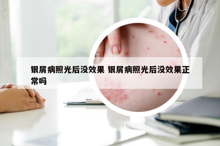 银屑病照光后没效果 银屑病照光后没效果正常吗