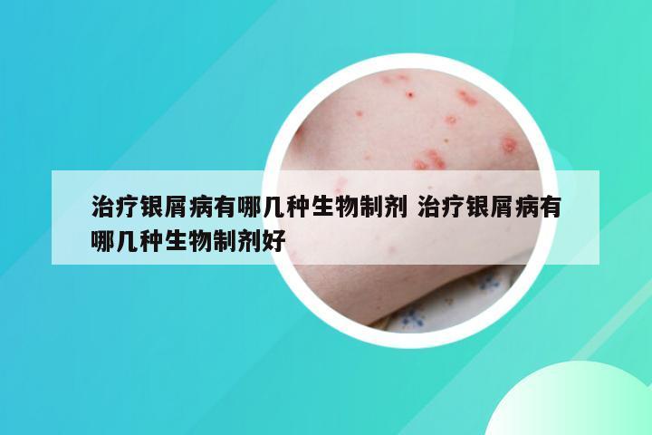 治疗银屑病有哪几种生物制剂 治疗银屑病有哪几种生物制剂好